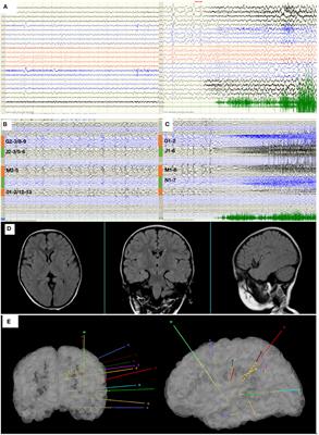 Magnetoencephalography STOUT Method Adapted to Radiofrequency Thermocoagulation for MR-Negative Insular Epilepsy: A Case Report